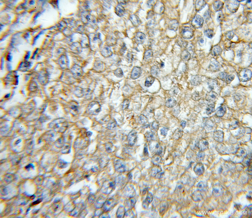Immunohistochemistry (IHC) staining of human lung cancer tissue using TBXAS1 Polyclonal antibody (11321-1-AP)