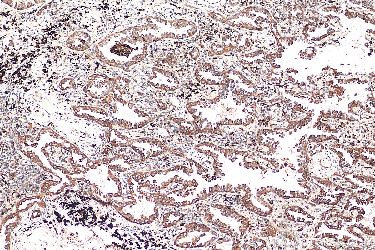 Immunohistochemistry (IHC) staining of human lung cancer tissue using TBXAS1 Monoclonal antibody (67371-1-Ig)