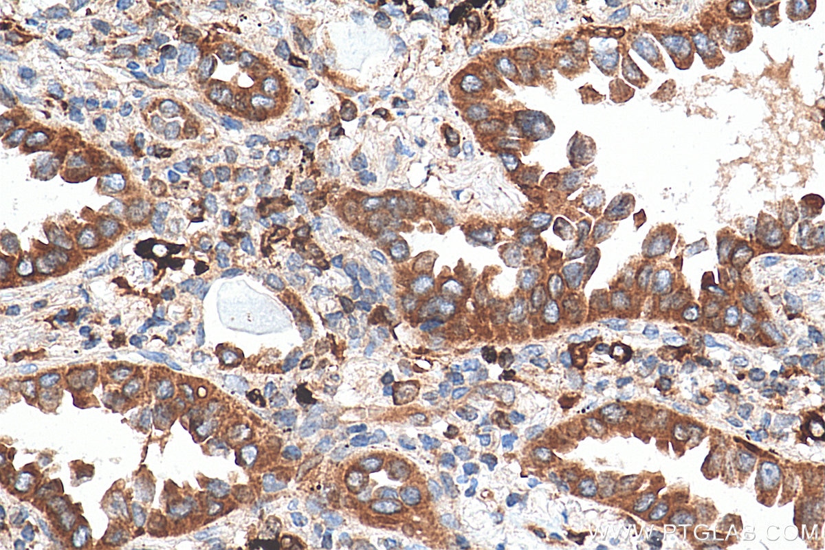 Immunohistochemistry (IHC) staining of human lung cancer tissue using TBXAS1 Monoclonal antibody (67371-1-Ig)