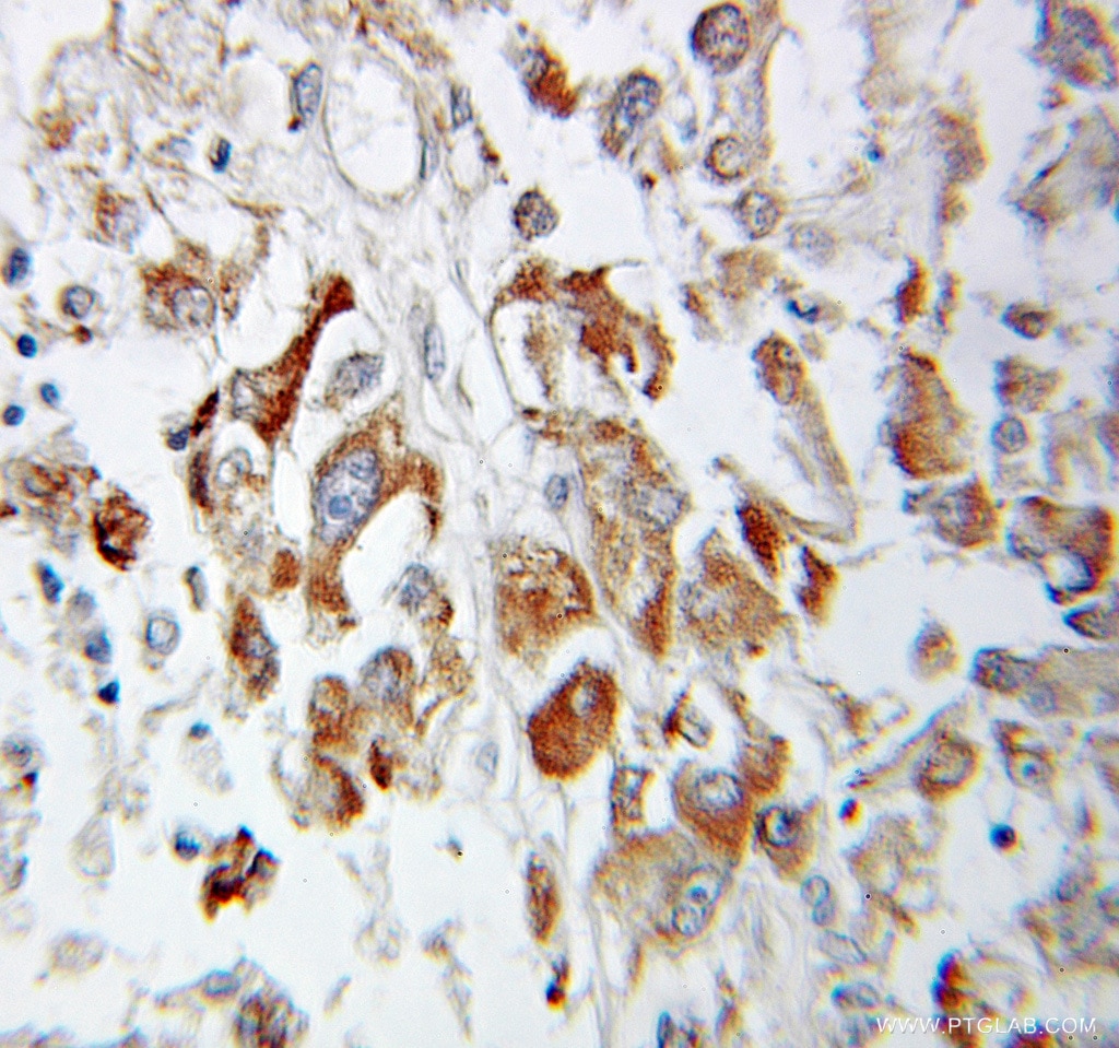 Immunohistochemistry (IHC) staining of human ovary tumor tissue using TCEAL3 Polyclonal antibody (10732-2-AP)