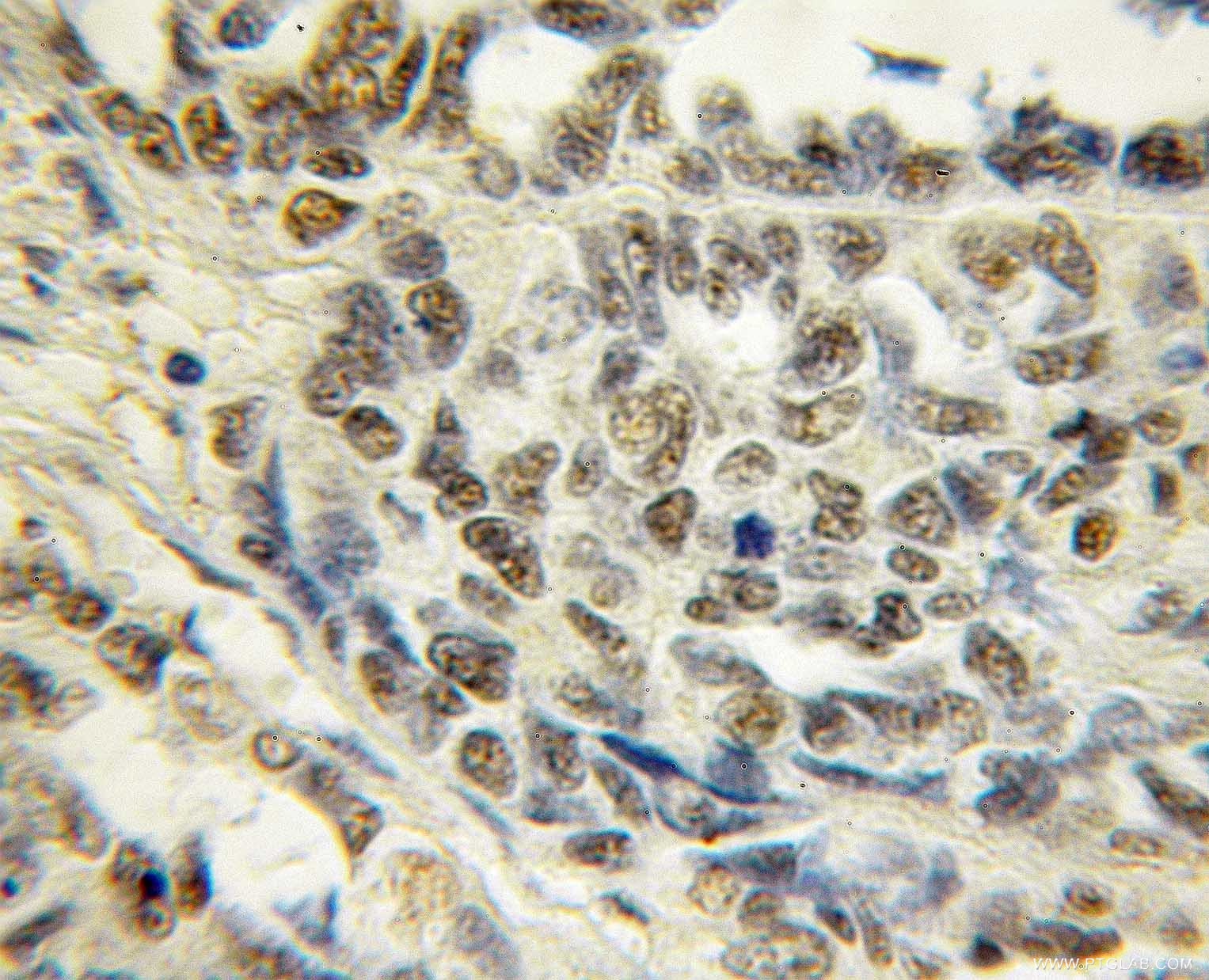 IHC staining of human ovary tumor using 11218-1-AP