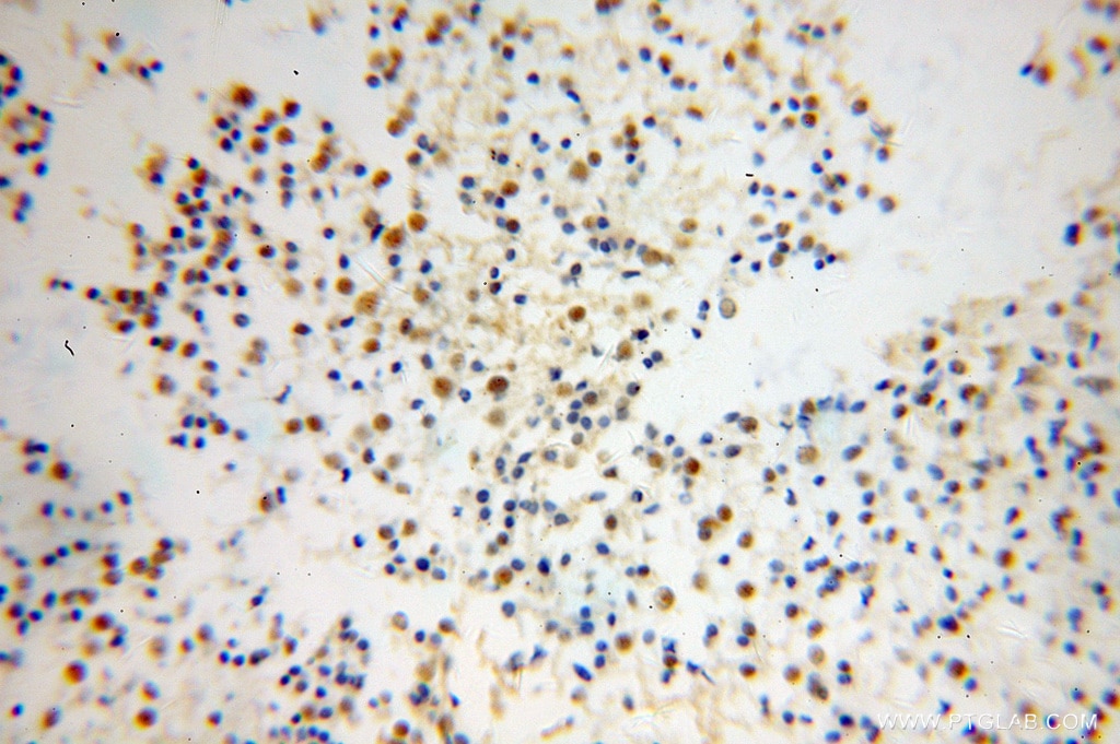 Immunohistochemistry (IHC) staining of human gliomas tissue using TCEAL7 Polyclonal antibody (11218-1-AP)