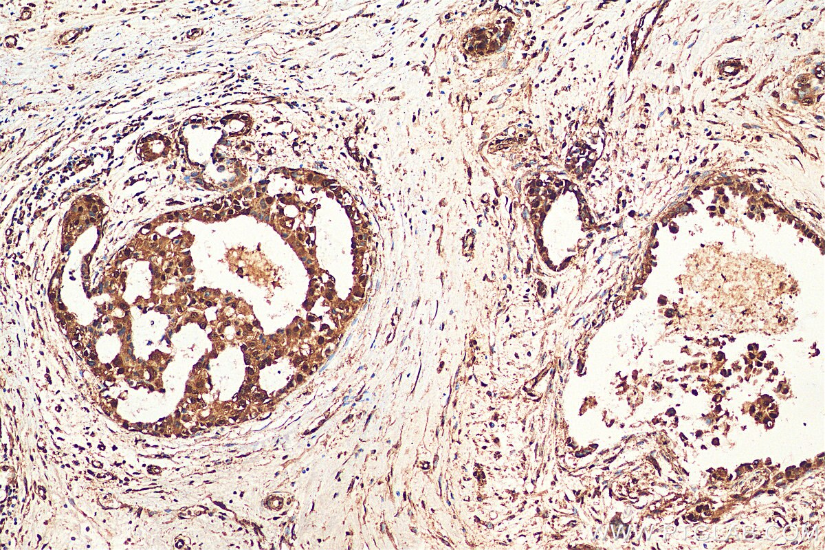 IHC staining of human breast cancer using 12450-1-AP