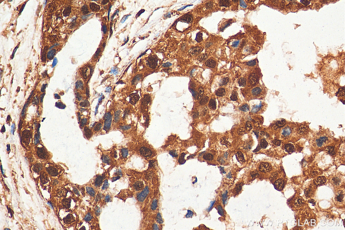 Immunohistochemistry (IHC) staining of human breast cancer tissue using TCEB1 Polyclonal antibody (12450-1-AP)