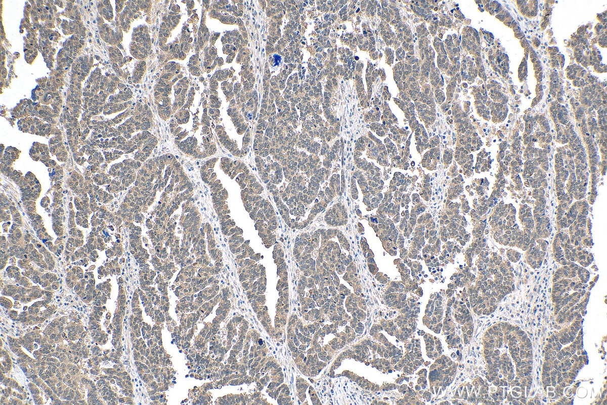Immunohistochemistry (IHC) staining of human ovary tumor tissue using TCEB1 Polyclonal antibody (12450-1-AP)