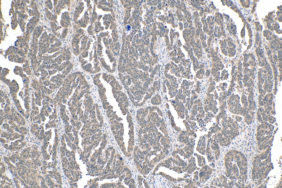 IHC staining of human ovary tumor using 12450-1-AP