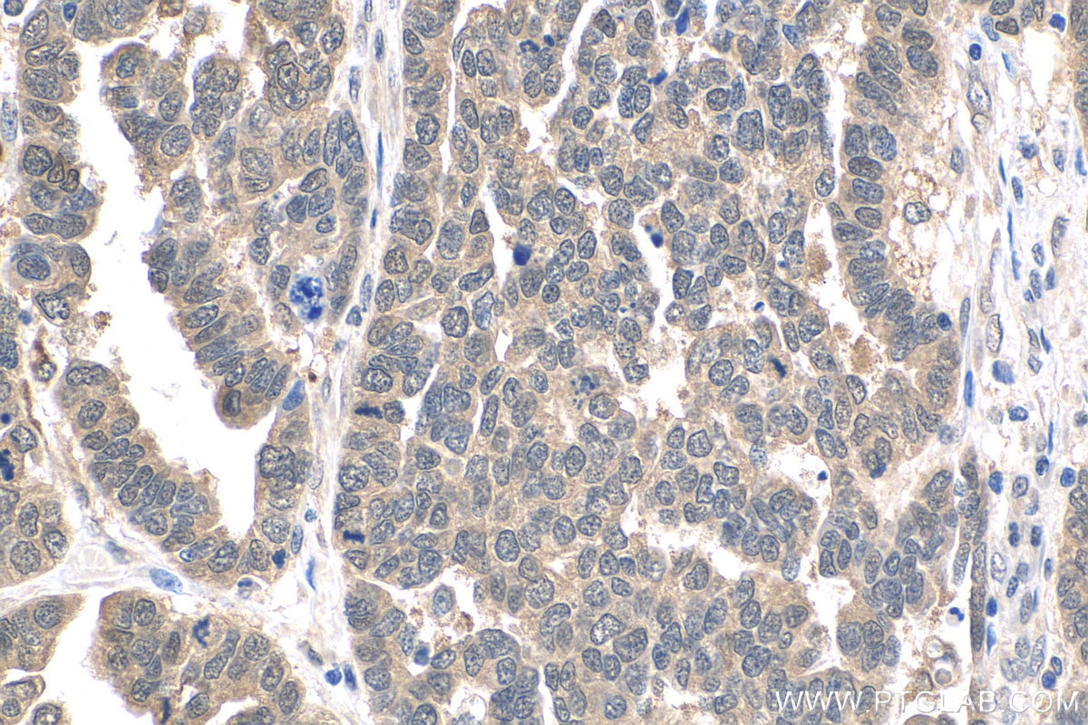 IHC staining of human ovary tumor using 12450-1-AP