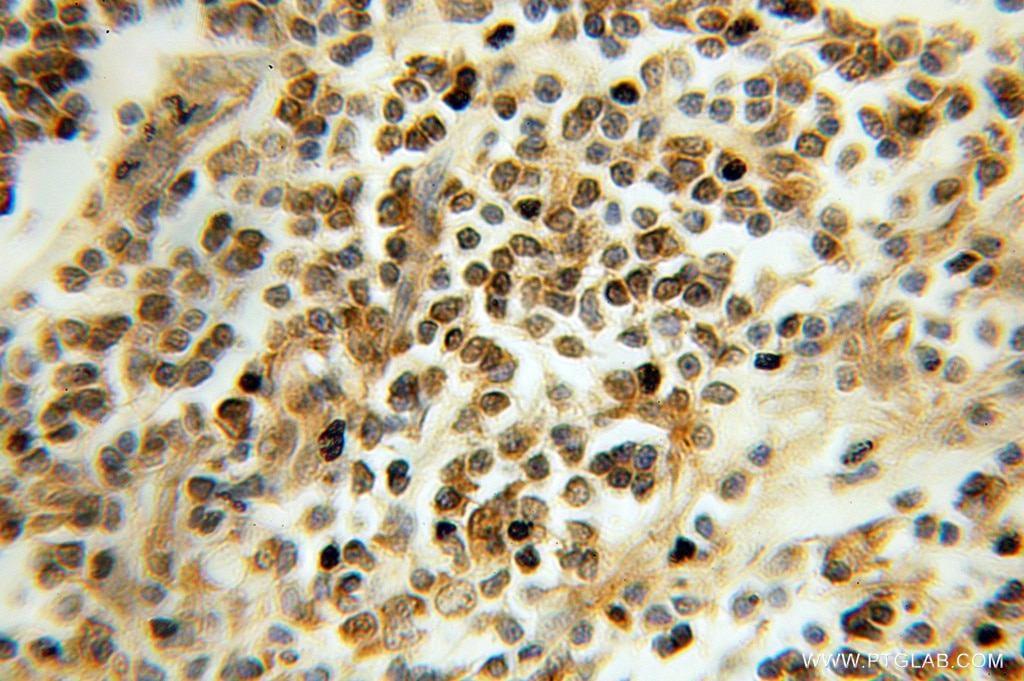Immunohistochemistry (IHC) staining of human colon cancer tissue using TCEB2/Elongin-B Polyclonal antibody (10779-1-AP)