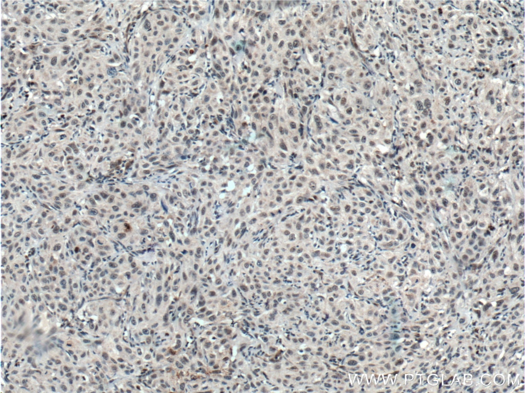 Immunohistochemistry (IHC) staining of human cervical cancer tissue using TCF12/HEB Polyclonal antibody (14419-1-AP)