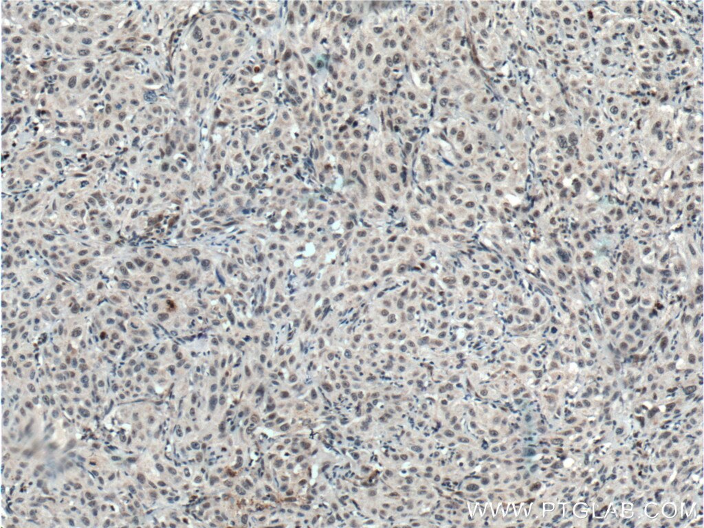 IHC staining of human cervical cancer using 14419-1-AP