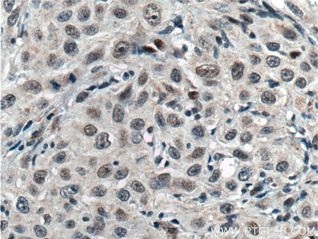 IHC staining of human cervical cancer using 14419-1-AP