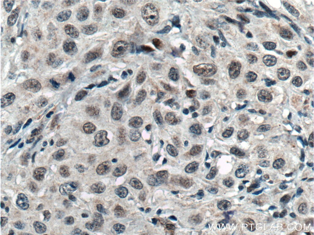 Immunohistochemistry (IHC) staining of human cervical cancer tissue using TCF12/HEB Polyclonal antibody (14419-1-AP)