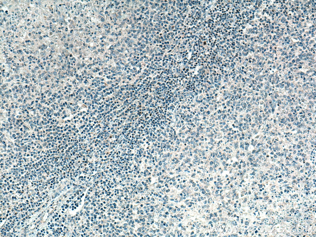 Immunohistochemistry (IHC) staining of human lymphoma tissue using TCF7 Polyclonal antibody (14464-1-AP)