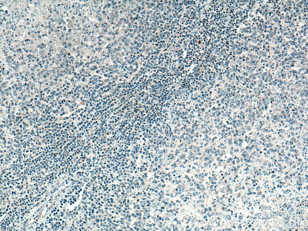 IHC staining of human lymphoma using 14464-1-AP