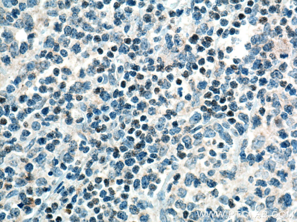 Immunohistochemistry (IHC) staining of human lymphoma tissue using TCF7 Polyclonal antibody (14464-1-AP)