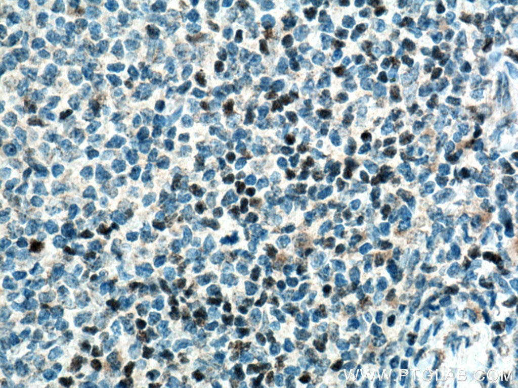 Immunohistochemistry (IHC) staining of human tonsillitis tissue using TCF7 Polyclonal antibody (14464-1-AP)