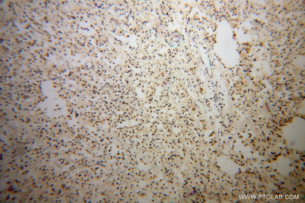 Immunohistochemistry (IHC) staining of human breast cancer tissue using TCF7L1 Polyclonal antibody (14519-1-AP)