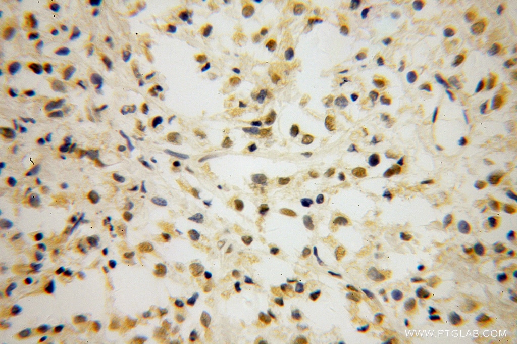 Immunohistochemistry (IHC) staining of human breast cancer tissue using TCF7L1 Polyclonal antibody (14519-1-AP)