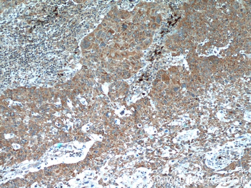 Immunohistochemistry (IHC) staining of human lung cancer tissue using TCL1A Polyclonal antibody (10475-1-AP)