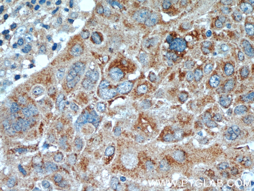 Immunohistochemistry (IHC) staining of human lung cancer tissue using TCL1A Polyclonal antibody (10475-1-AP)