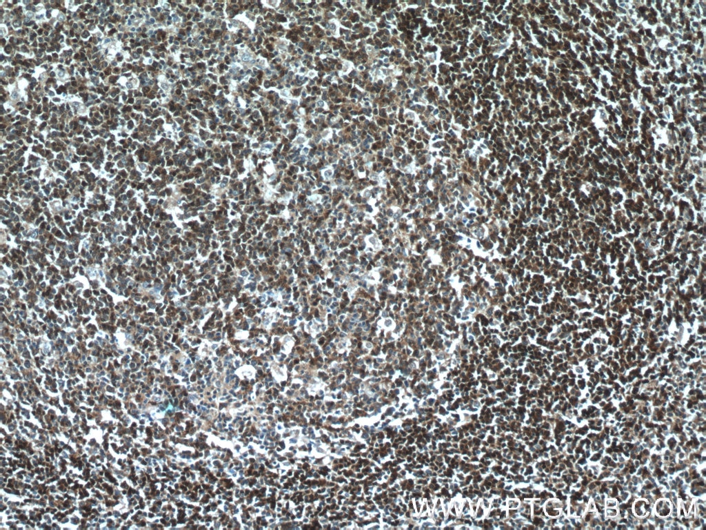 Immunohistochemistry (IHC) staining of human tonsillitis tissue using TCL1A Polyclonal antibody (10475-1-AP)