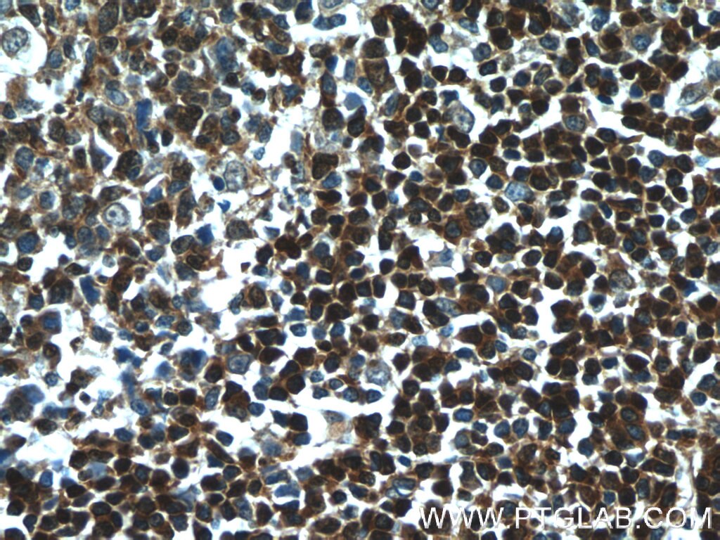 Immunohistochemistry (IHC) staining of human tonsillitis tissue using TCL1A Polyclonal antibody (10475-1-AP)