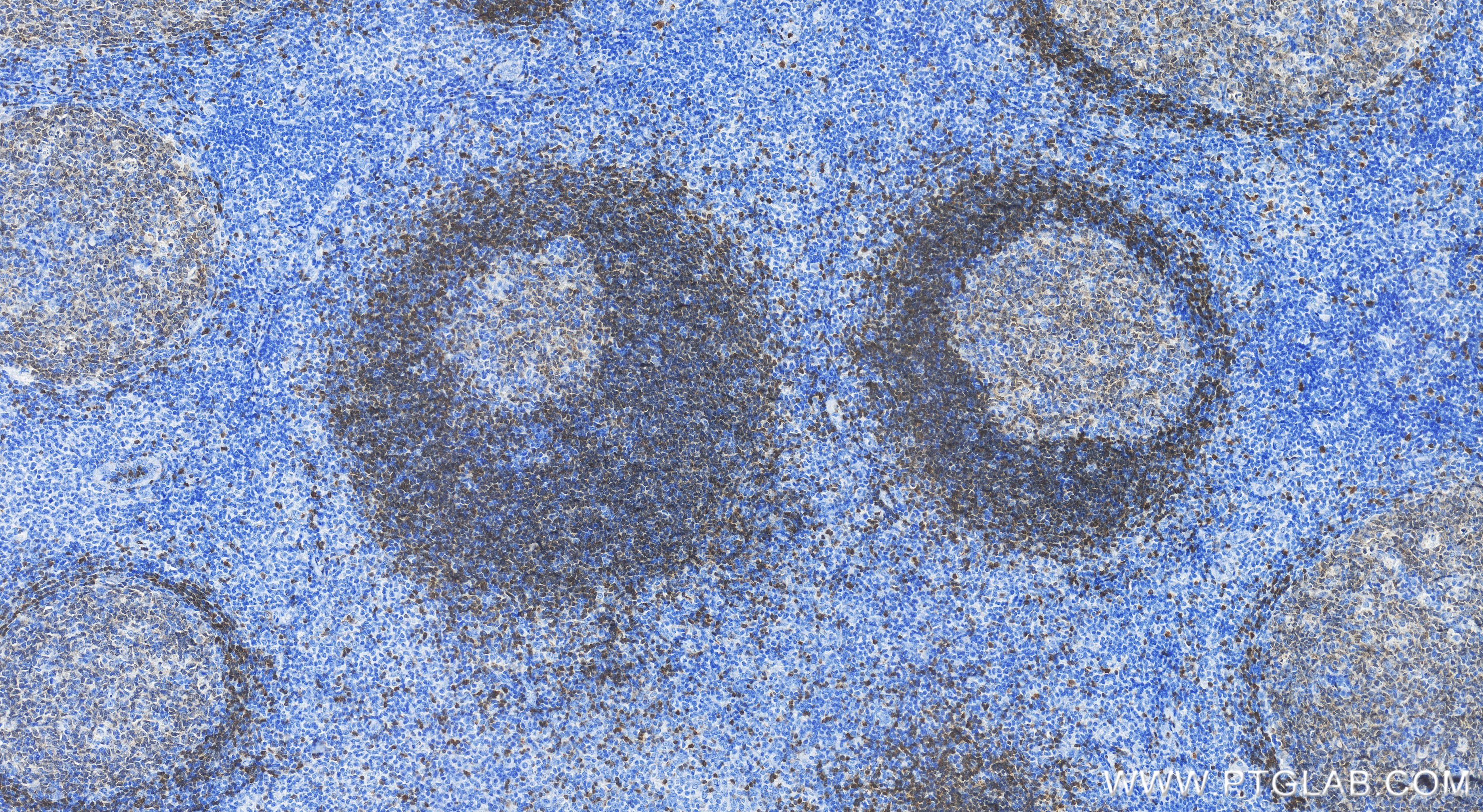Immunohistochemistry (IHC) staining of human tonsillitis tissue using TCL1A Recombinant antibody (85129-5-RR)