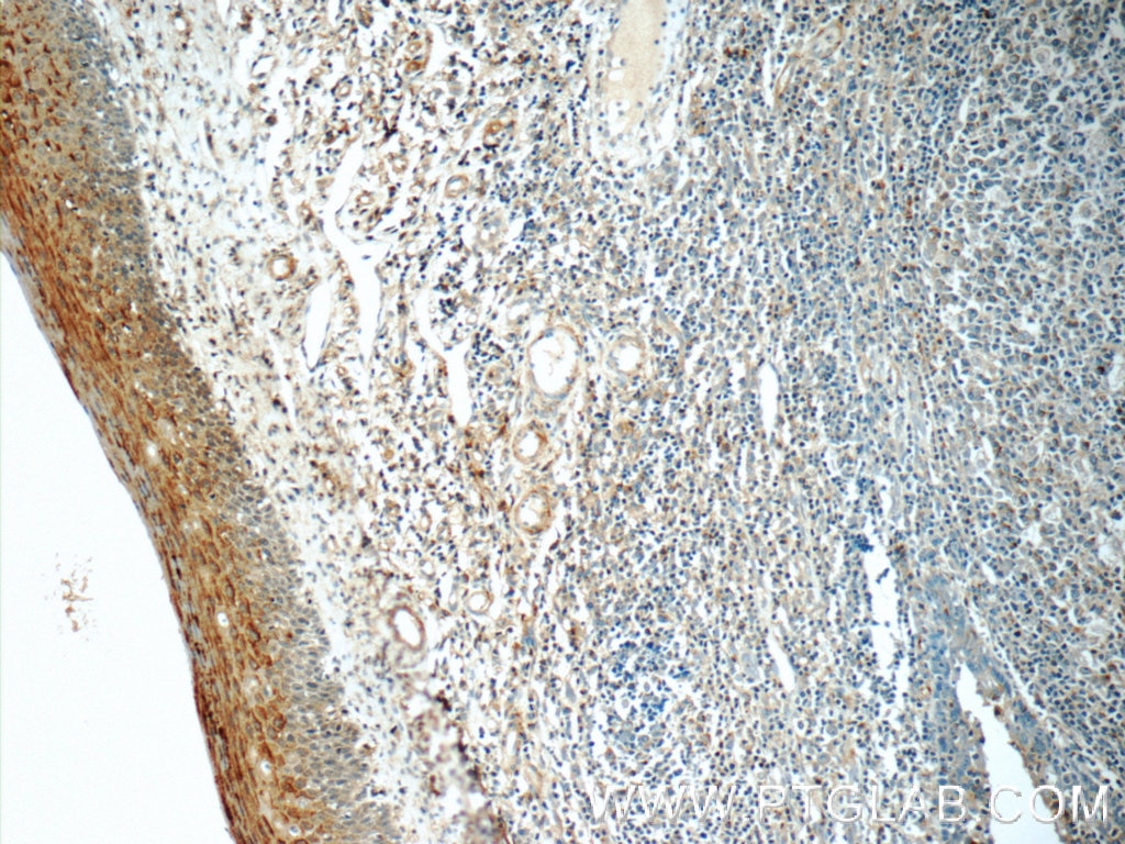 Immunohistochemistry (IHC) staining of human tonsillitis tissue using TCN1 Polyclonal antibody (16078-1-AP)