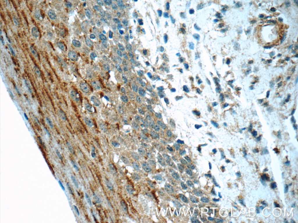 IHC staining of human tonsillitis using 16078-1-AP