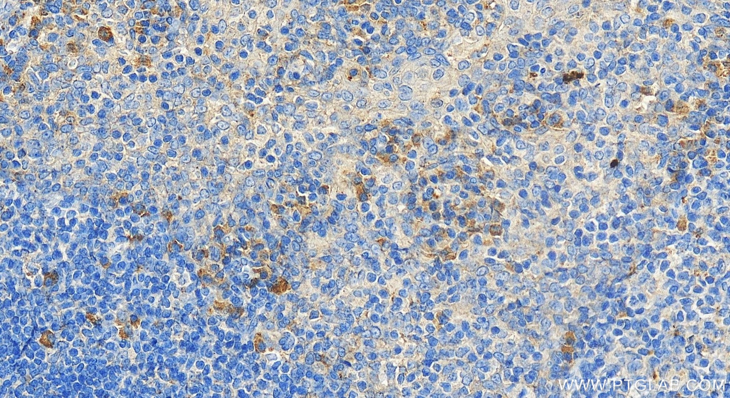 Immunohistochemistry (IHC) staining of human tonsillitis tissue using TCN1 Polyclonal antibody (16078-1-AP)