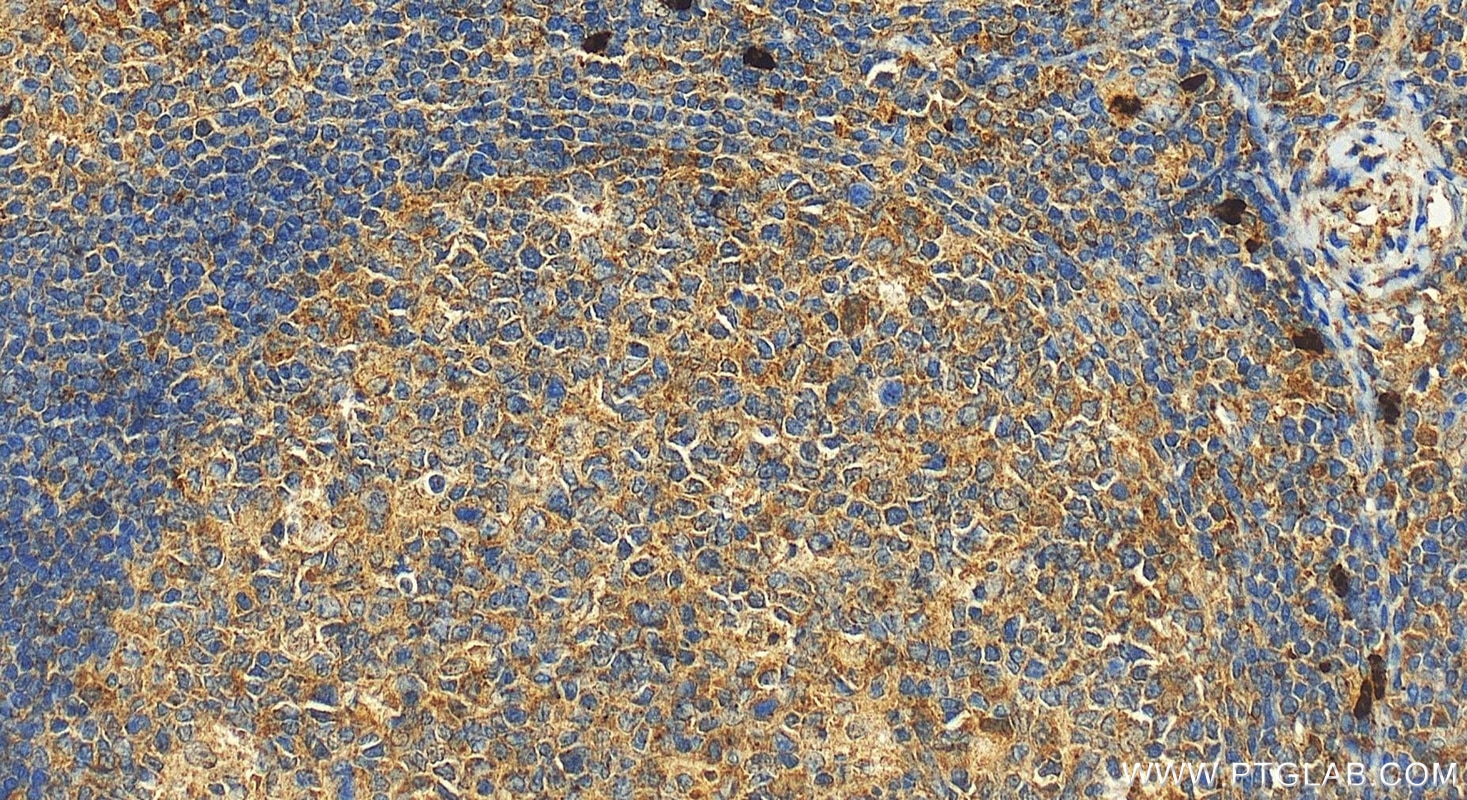 Immunohistochemistry (IHC) staining of human tonsillitis tissue using TCN1 Polyclonal antibody (16078-1-AP)