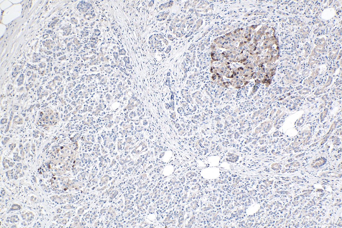 Immunohistochemistry (IHC) staining of human pancreas cancer tissue using TCN2 Polyclonal antibody (12157-1-AP)