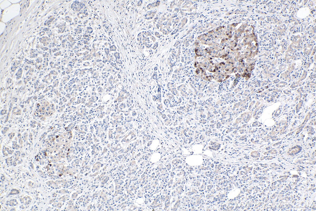 IHC staining of human pancreas cancer using 12157-1-AP