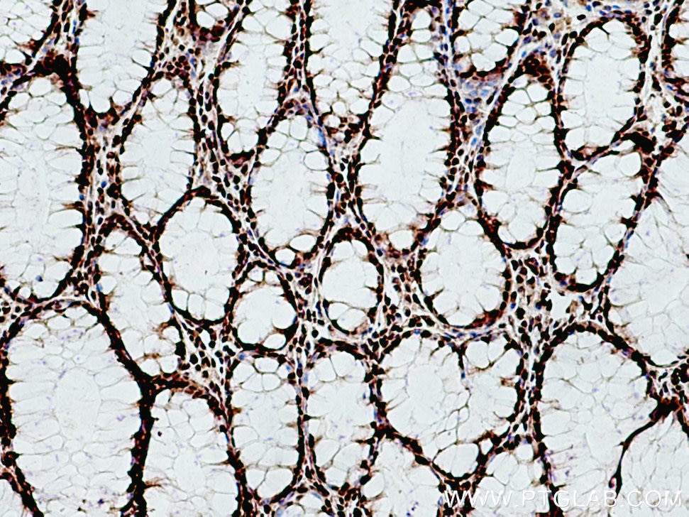 Immunohistochemistry (IHC) staining of human colon cancer tissue using TCOF1 Polyclonal antibody (11003-1-AP)