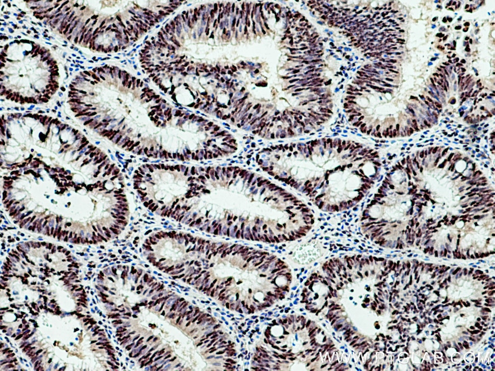 Immunohistochemistry (IHC) staining of human colon cancer tissue using TCOF1 Polyclonal antibody (11003-1-AP)
