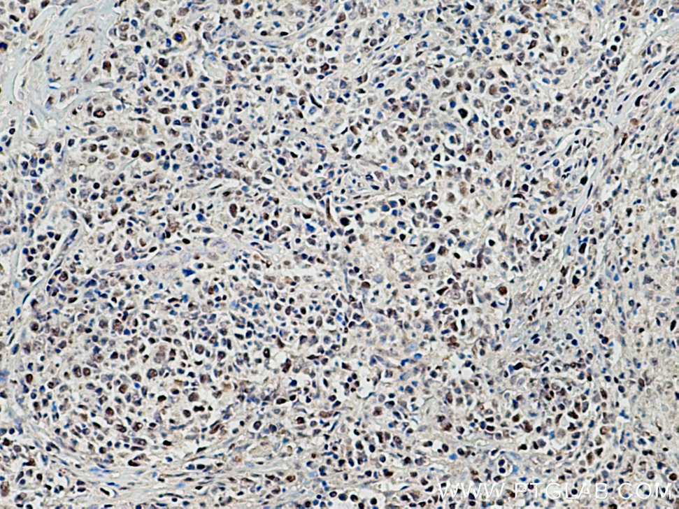 Immunohistochemistry (IHC) staining of human lymphoma tissue using TCOF1 Polyclonal antibody (11003-1-AP)