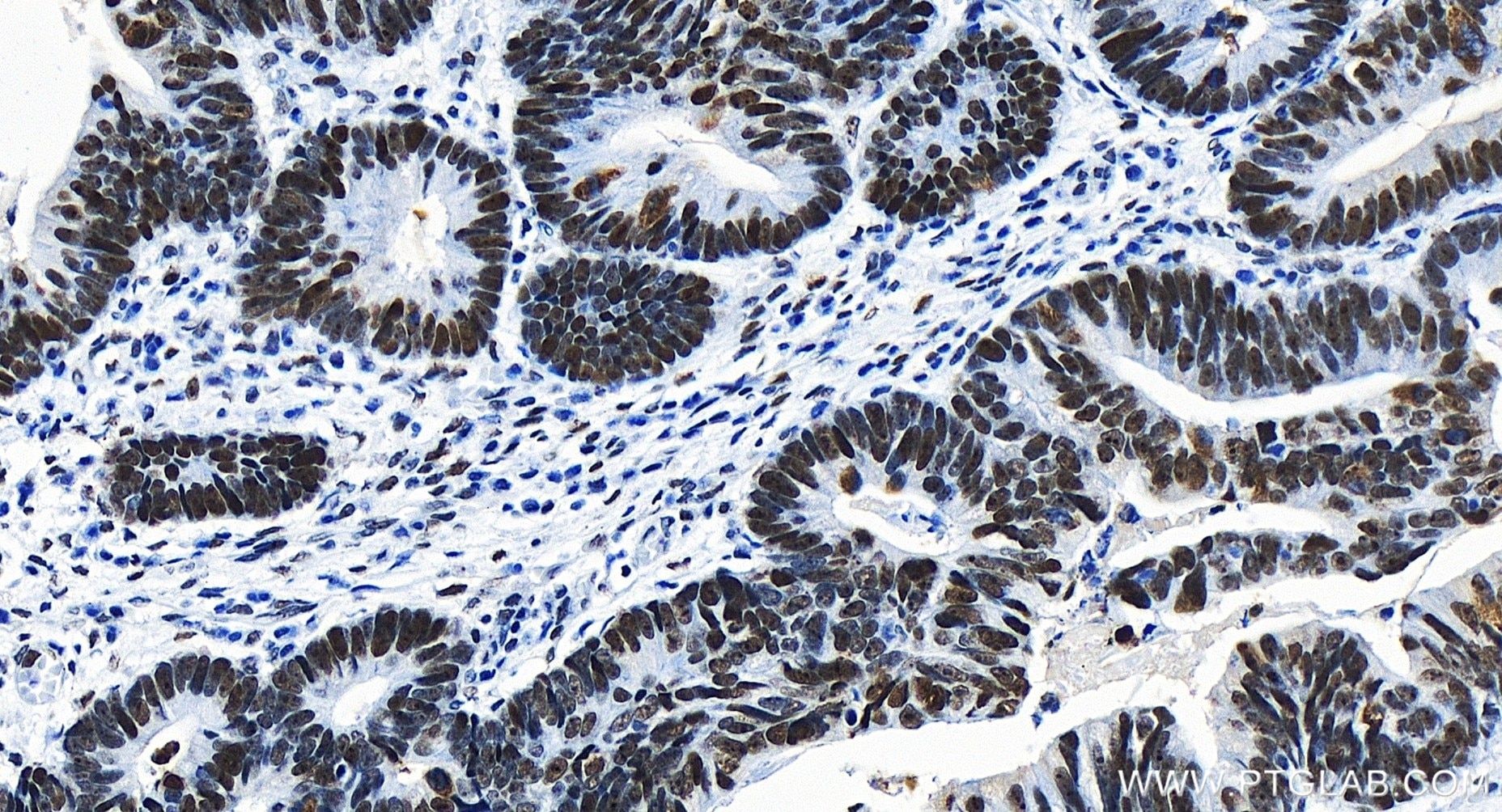 Immunohistochemistry (IHC) staining of human colon cancer tissue using TCOF1 Recombinant antibody (84914-4-RR)