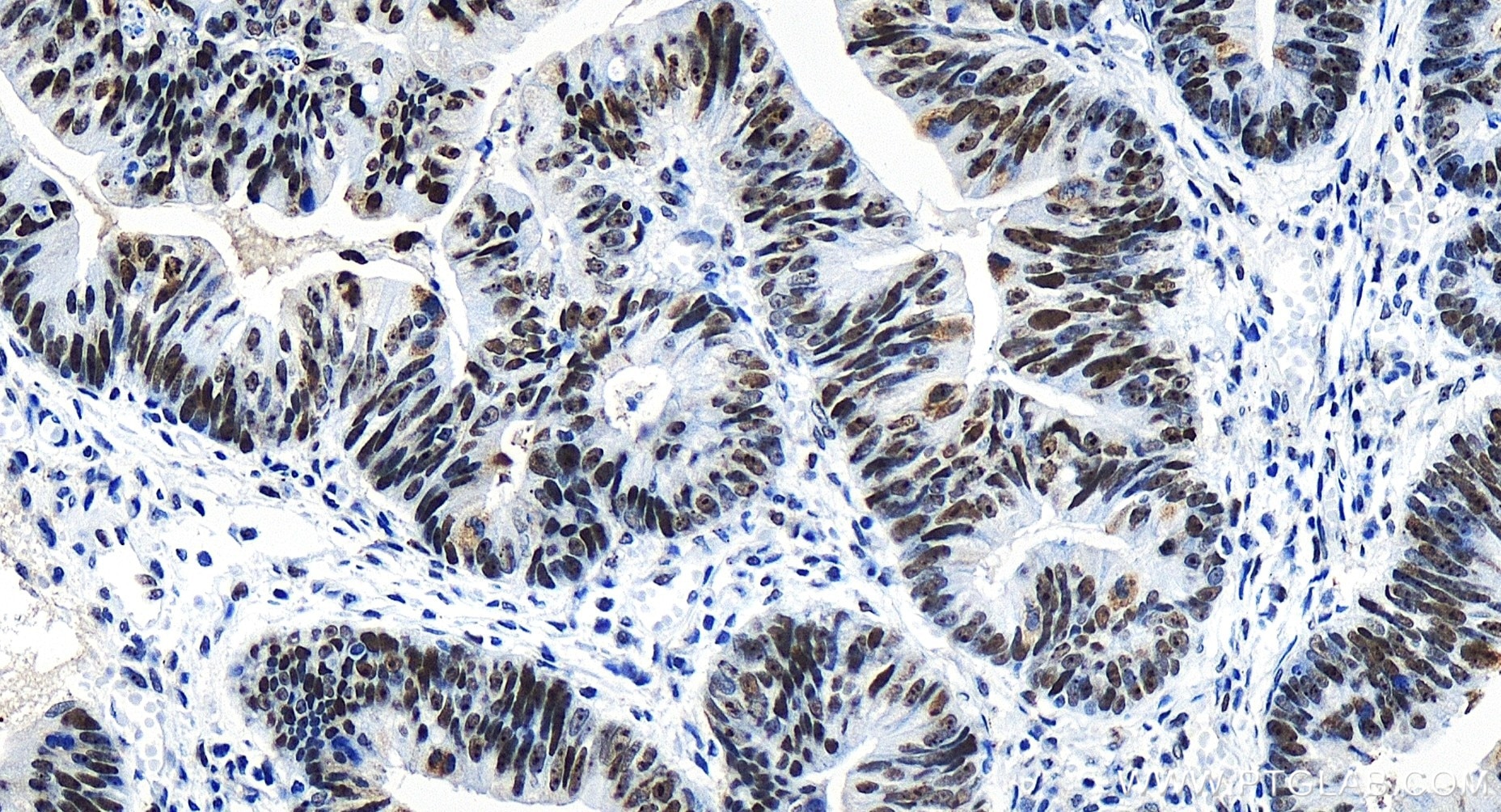 Immunohistochemistry (IHC) staining of human colon cancer tissue using TCOF1 Recombinant antibody (84914-5-RR)
