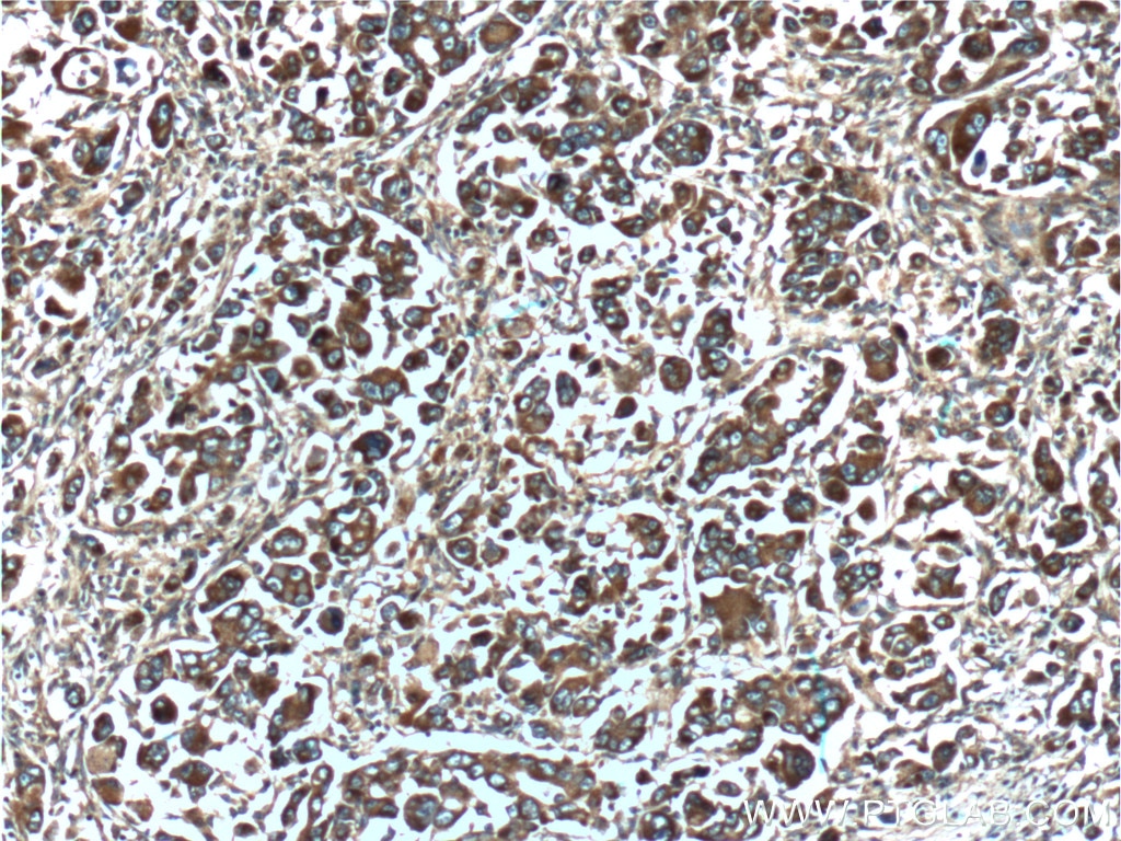 Immunohistochemistry (IHC) staining of human liver cancer tissue using TCP1 Polyclonal antibody (10320-1-AP)