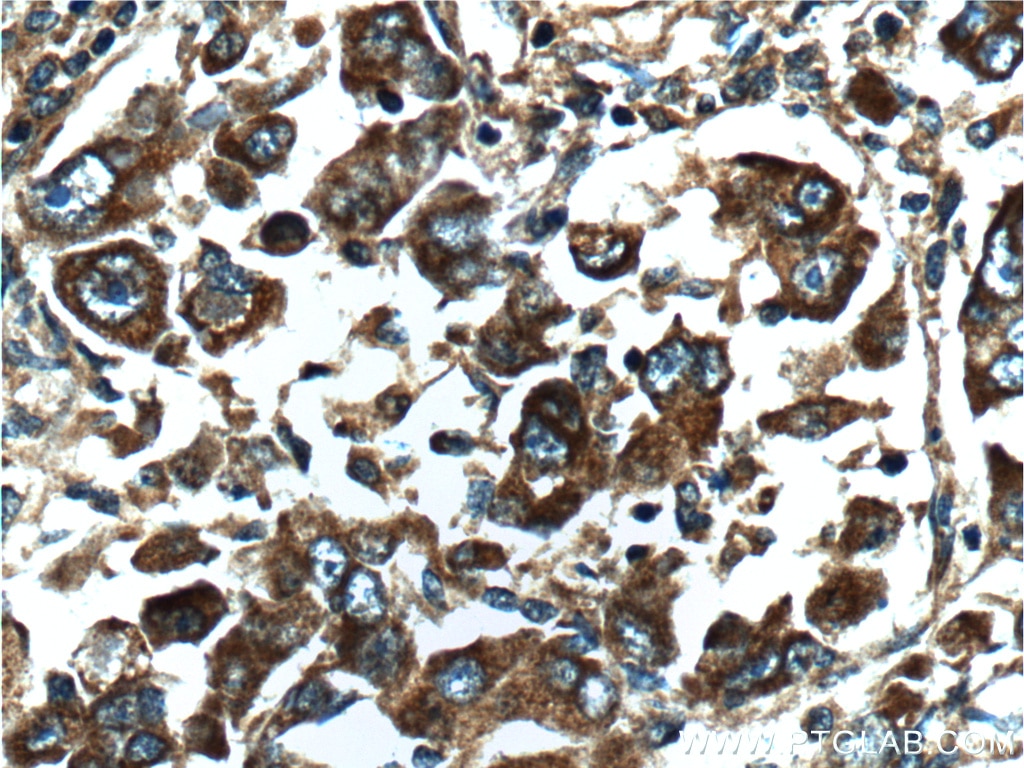 Immunohistochemistry (IHC) staining of human liver cancer tissue using TCP1 Polyclonal antibody (10320-1-AP)
