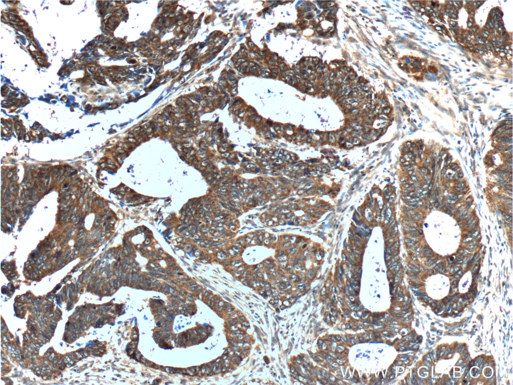 Immunohistochemistry (IHC) staining of human colon cancer tissue using TCP1 Polyclonal antibody (10320-1-AP)