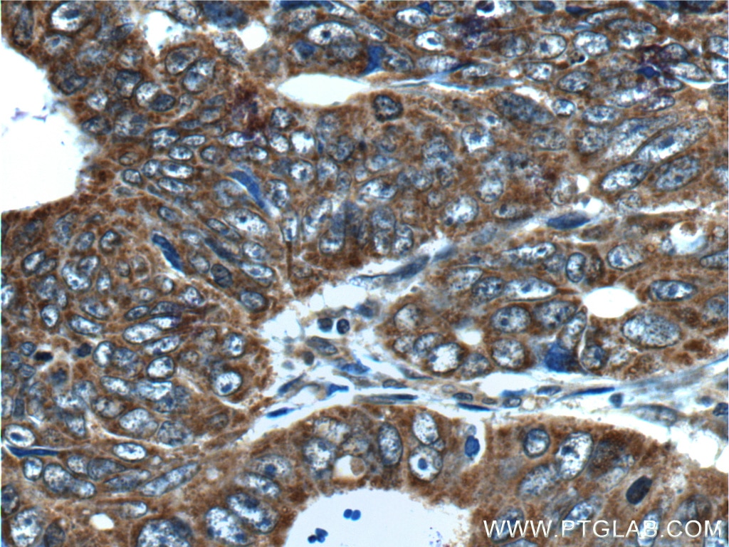 Immunohistochemistry (IHC) staining of human colon cancer tissue using TCP1 Polyclonal antibody (10320-1-AP)