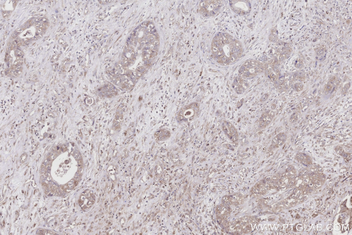 IHC staining of human pancreas cancer using 68183-1-Ig Immunohistochemistry (IHC) staining of human pancreas cancer tissue using TCP1 Monoclonal antibody (68183-1-Ig)