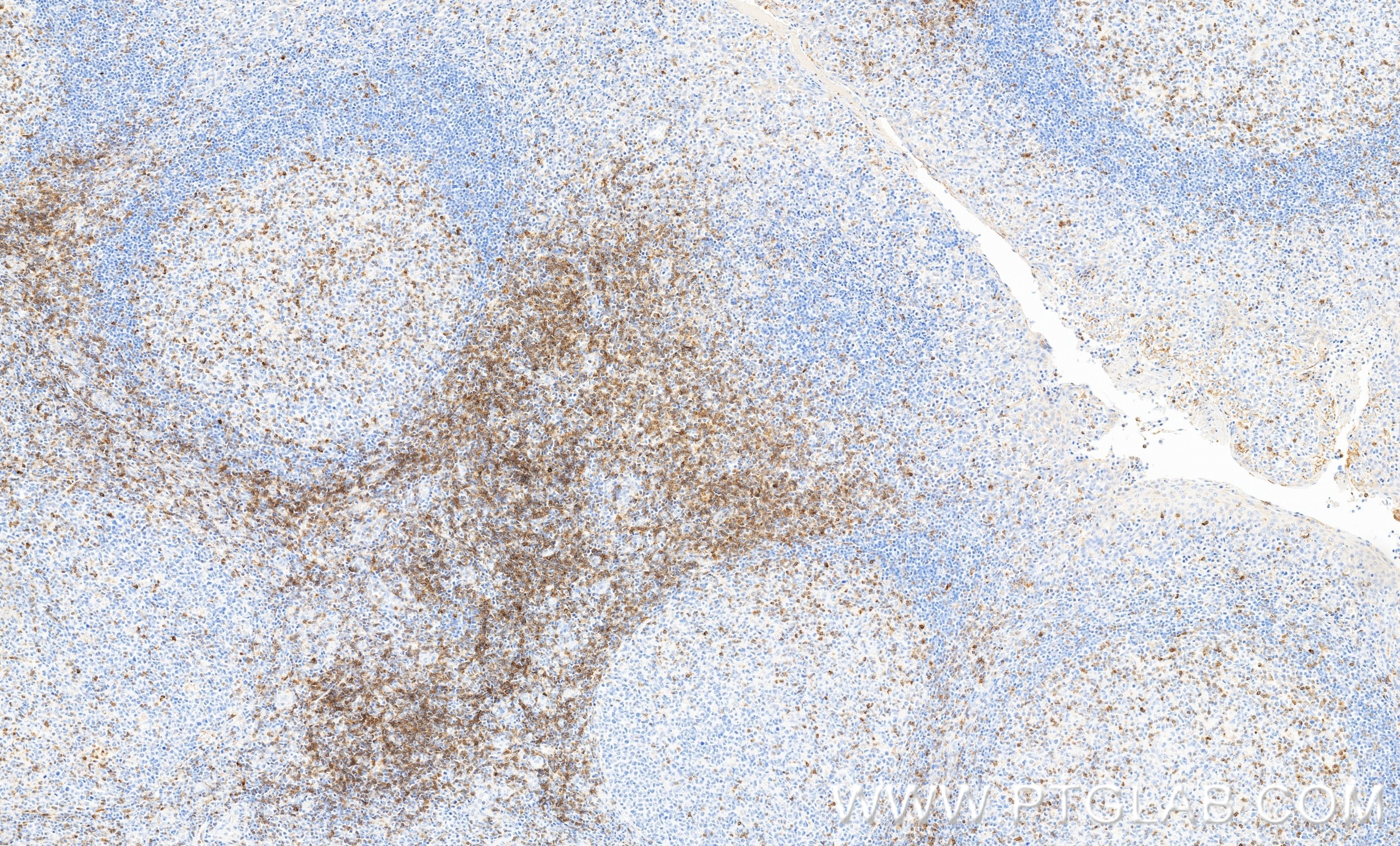 Immunohistochemistry (IHC) staining of human tonsillitis tissue using TCR α/β Recombinant monoclonal antibody (87509-1-RR)