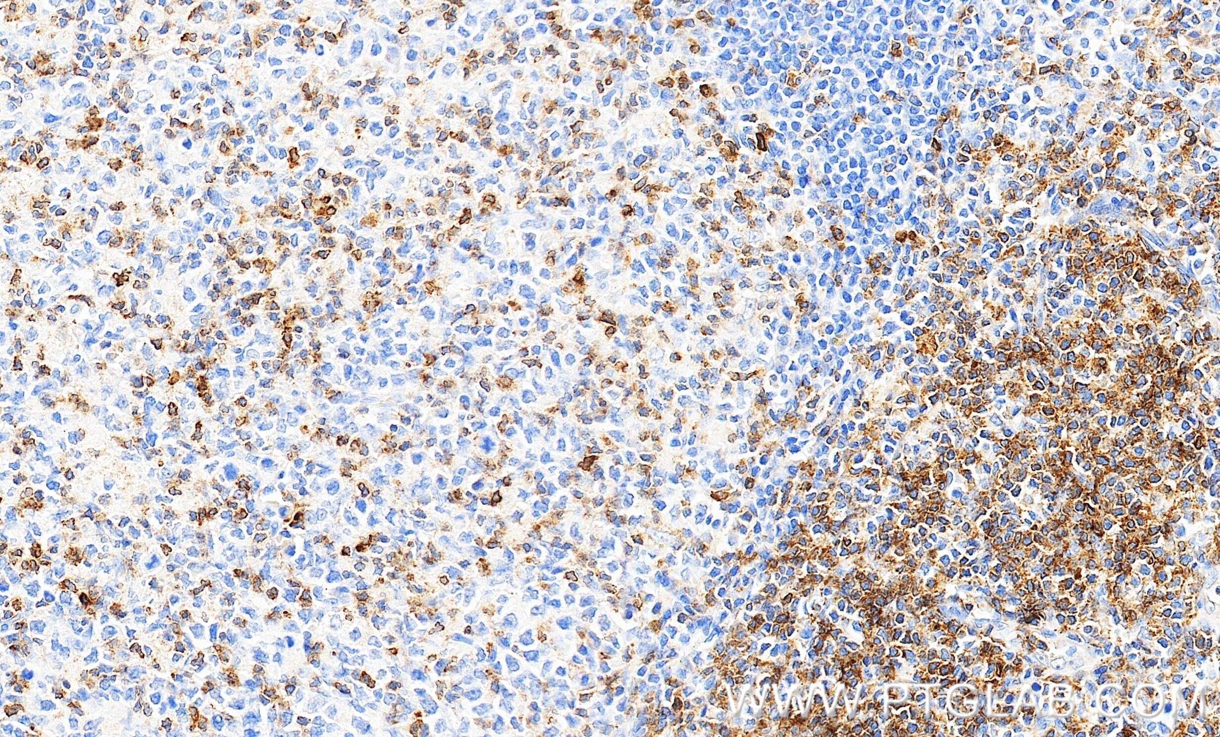 Immunohistochemistry (IHC) staining of human tonsillitis tissue using TCR α/β Recombinant monoclonal antibody (87509-1-RR)