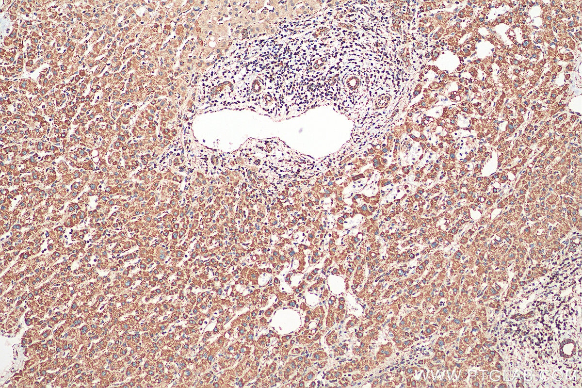 Immunohistochemistry (IHC) staining of human liver cancer tissue using TCTN2 Polyclonal antibody (17053-1-AP)