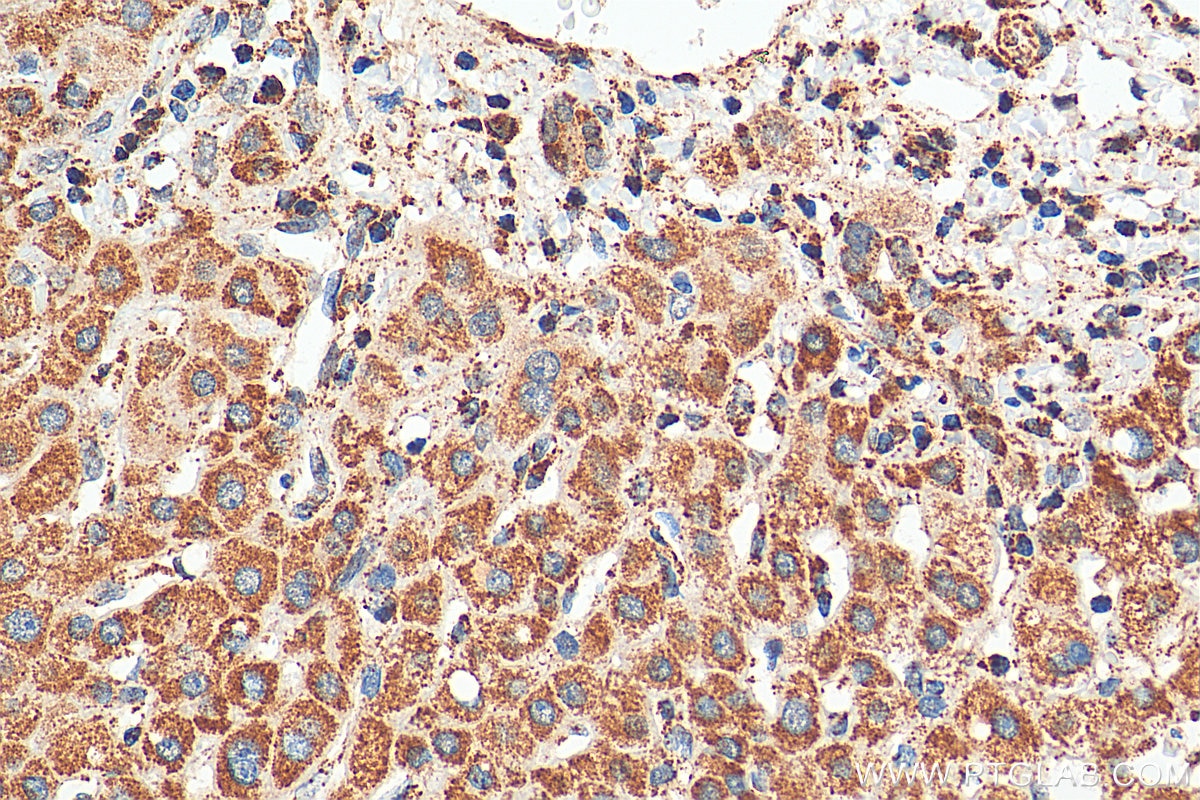 Immunohistochemistry (IHC) staining of human liver cancer tissue using TCTN2 Polyclonal antibody (17053-1-AP)