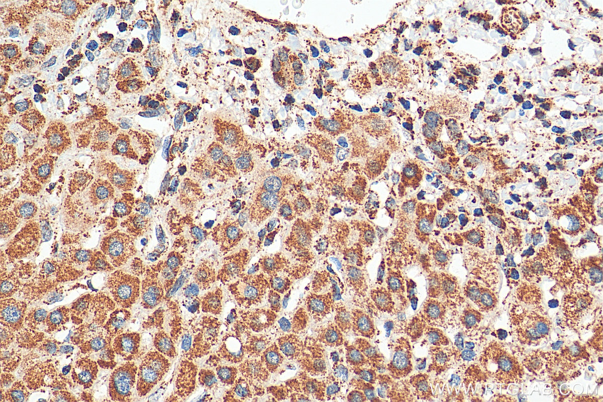 IHC staining of human liver cancer using 17053-1-AP