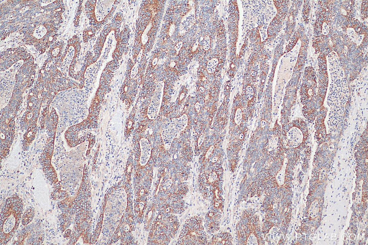 Immunohistochemistry (IHC) staining of human colon cancer tissue using TCTN2 Polyclonal antibody (17053-1-AP)