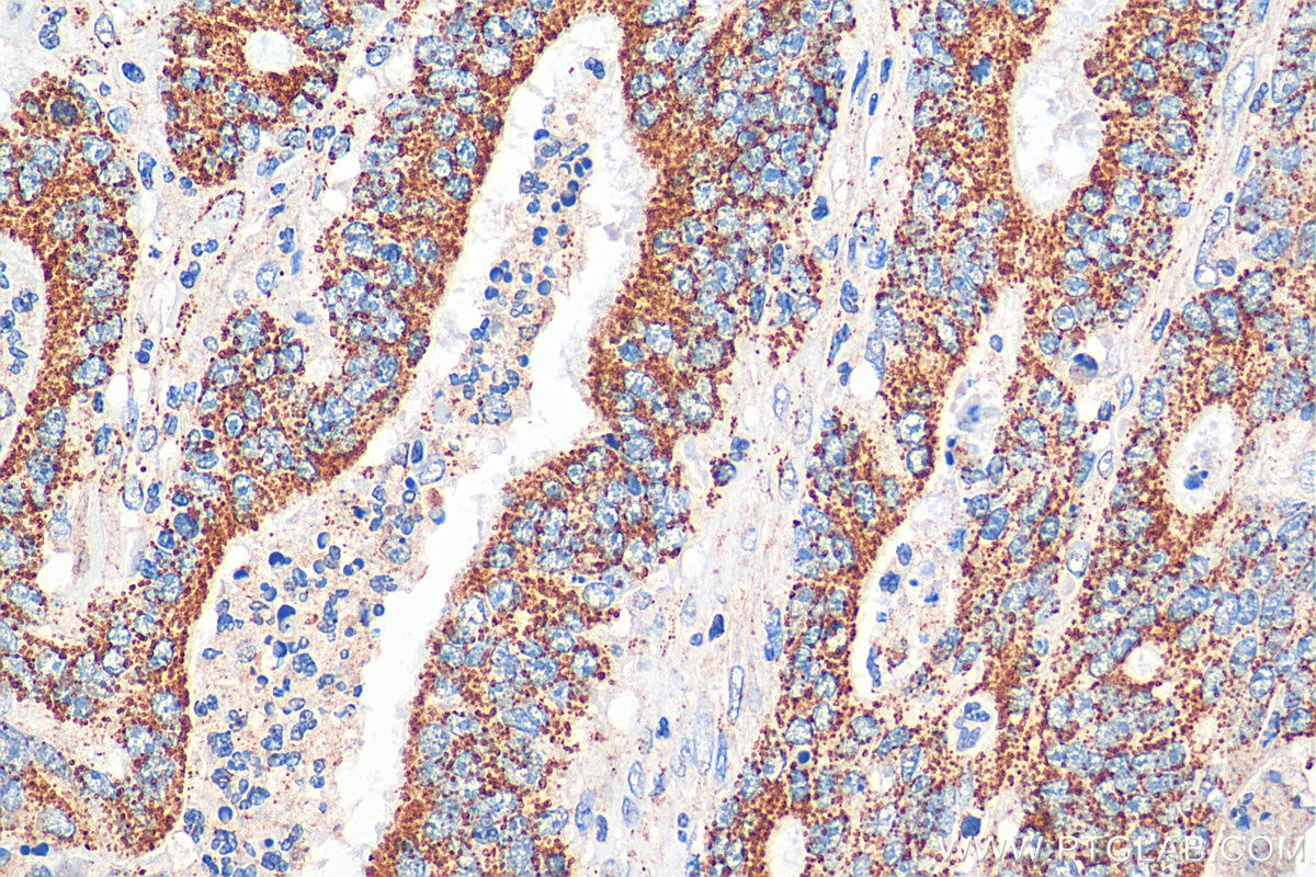 Immunohistochemistry (IHC) staining of human colon cancer tissue using TCTN2 Polyclonal antibody (17053-1-AP)